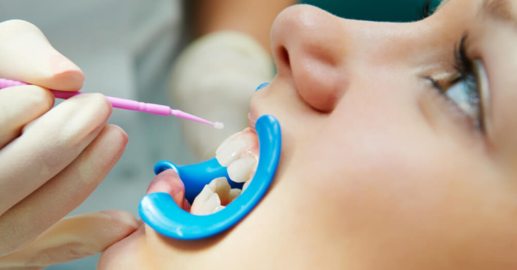 Dental Sealants for Kids and Teens: Protecting Smiles