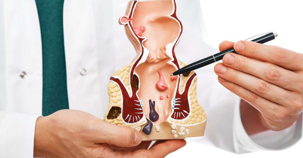 Hemorrhoids Treatment from Manhattan Gastroenterology