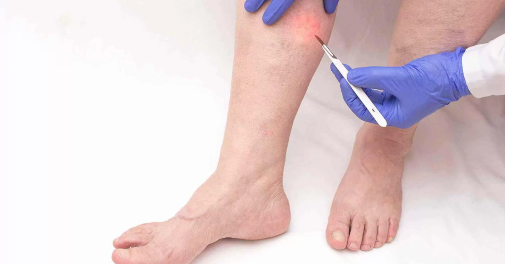 Say Goodbye to Varicose Veins with Ambulatory Phlebotomy