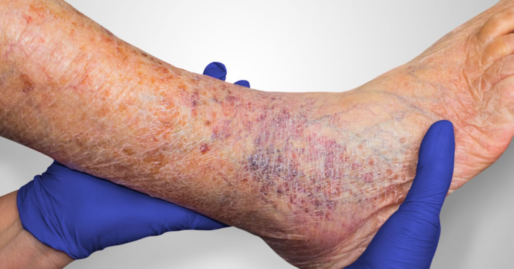 Advanced Treatments for Venous stasis Ulcers