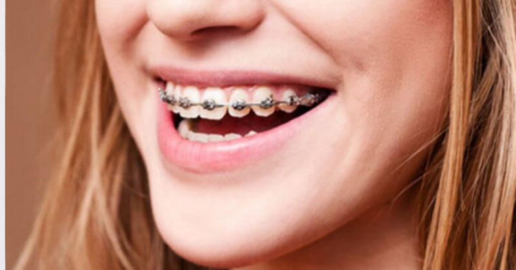 Braces Retainers: Essential Tips for Maintaining Smile