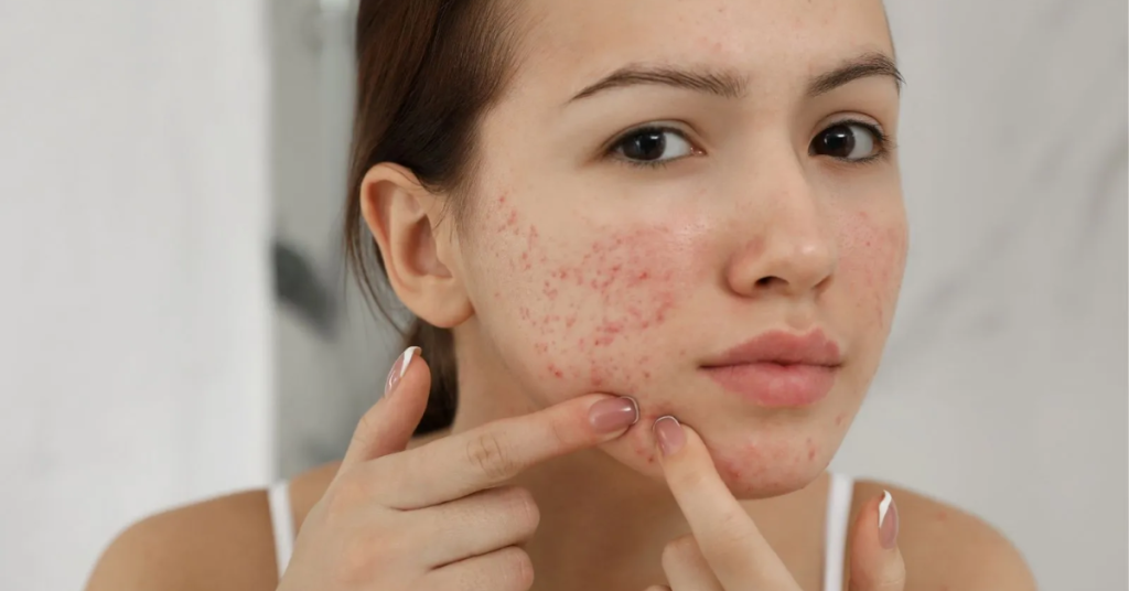 Managing Acne: From Mild to Severe Breakouts