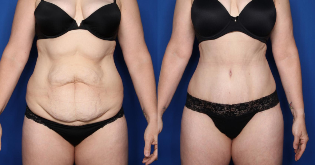 What Is a Tummy Tuck or Abdominoplasty?