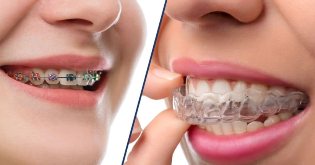 Traditional Braces vs. Invisalign: Which Is Right for You?