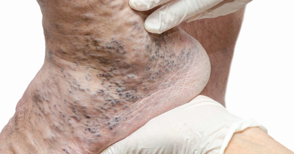 Venous Stasis Ulcer Healing in Brooklyn, NY