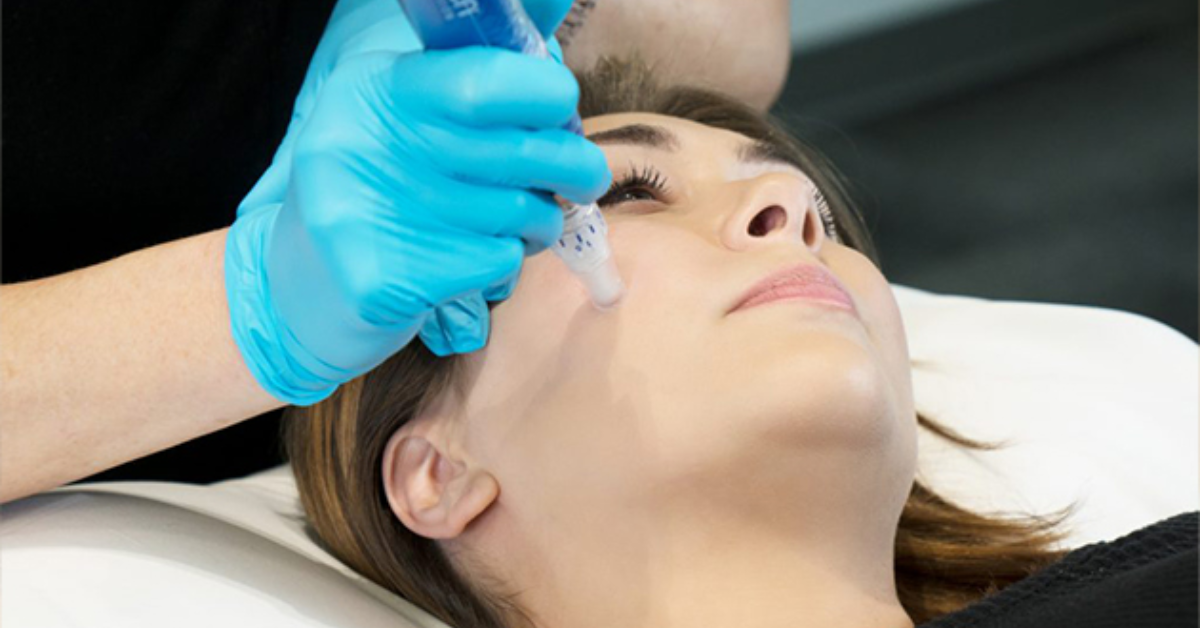 SkinPen Microneedling: A Guide to Youthful Skin